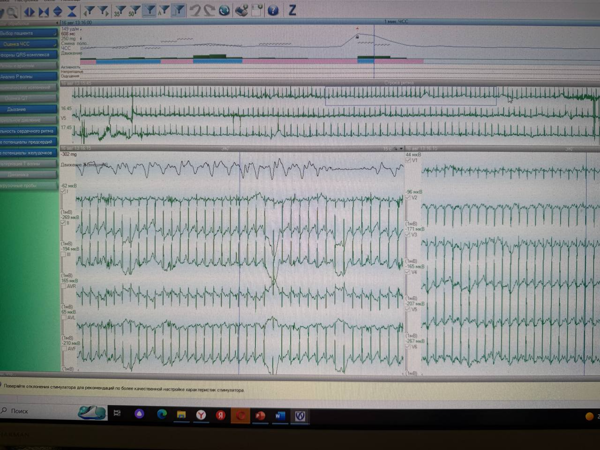 Очень частый сердечный ритм, но это ритм синусовый, т.е. из того водителя ритма, который у нас и в норме функционирует
