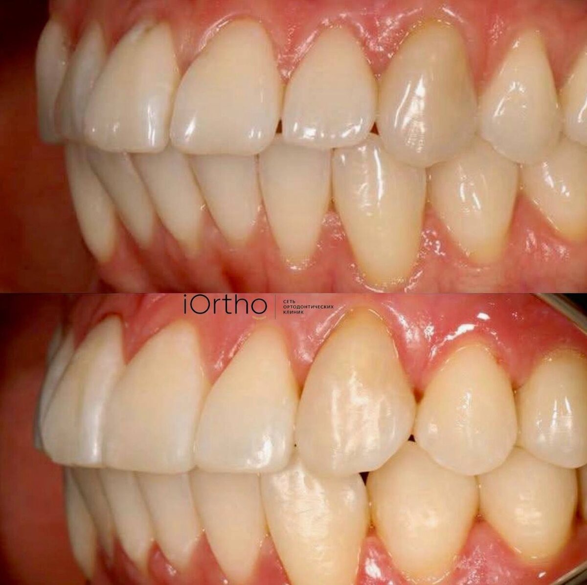 Лечение на элайнерах в клинике iOrtho: результат до/после