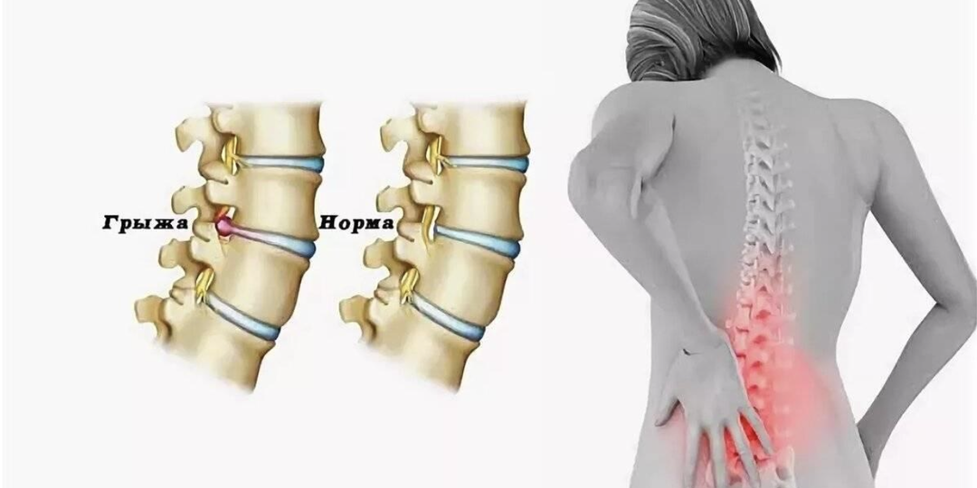 ГРЫЖА: РЕЗАТЬ ИЛИ ЖДАТЬ? ЖИЗНЕННО ВАЖНЫЙ ВЫБОР, КОТОРЫЙ МОЖЕТ СПАСТИ ВАМ СПИНУ — ИЛИ УНИЧТОЖИТЬ ЕЁ