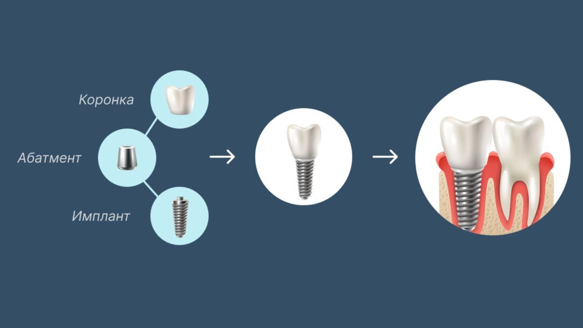 Как устроен имплант? Это титановый стержень, который имитирует коронку зуба. На этот стержень с помощью абатмента фиксируется коронка. 
