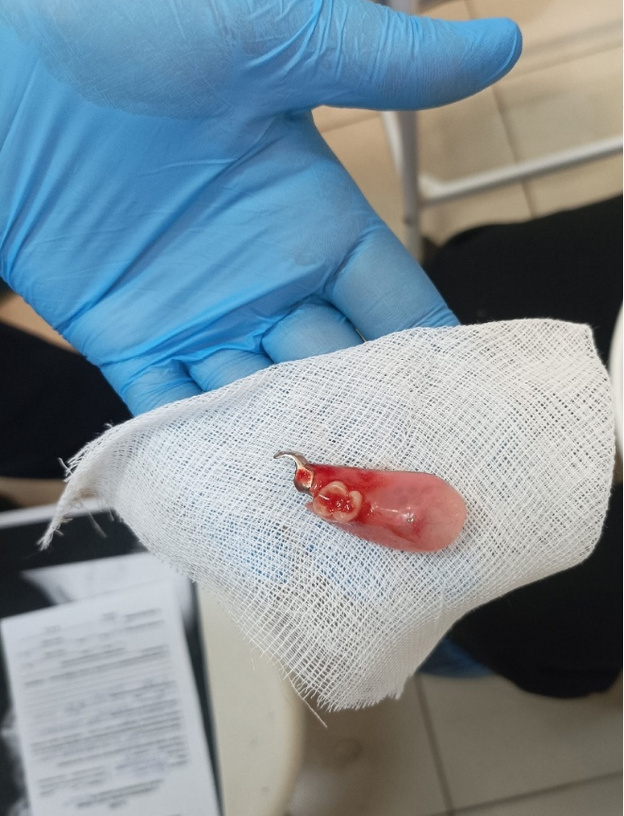    Кировские врачи извлекли зубной протез из горла пациентки