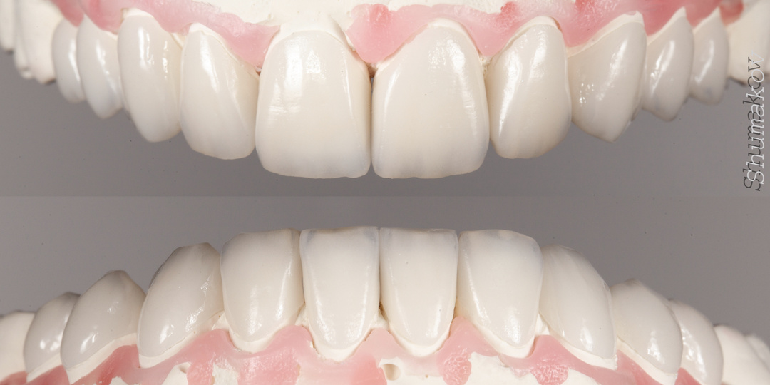 Виниры портят зубы?Правда? Разбираем главный миф.