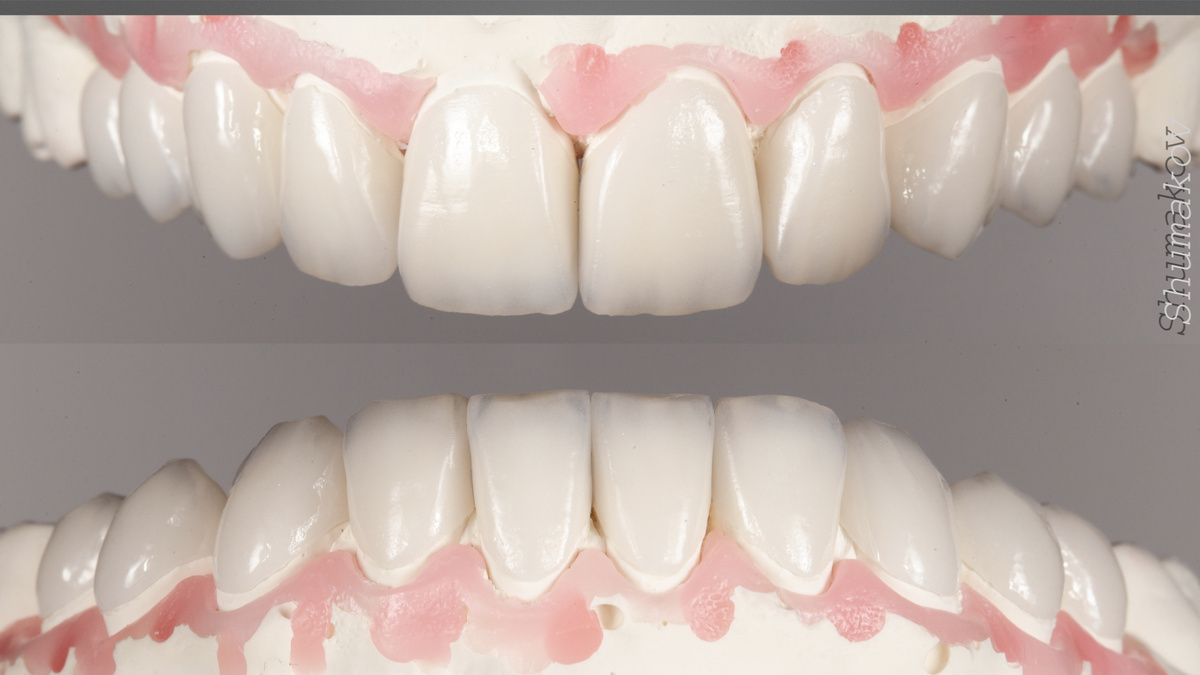 Авторские высокоэстетичные виниры.Стоматология Евродент.