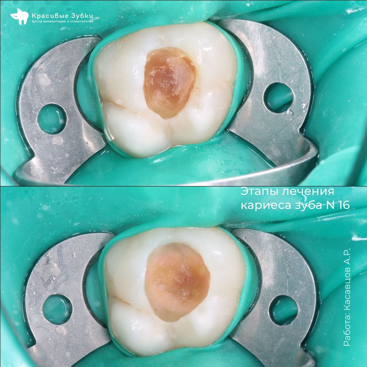 Этапы лечения кариеса
