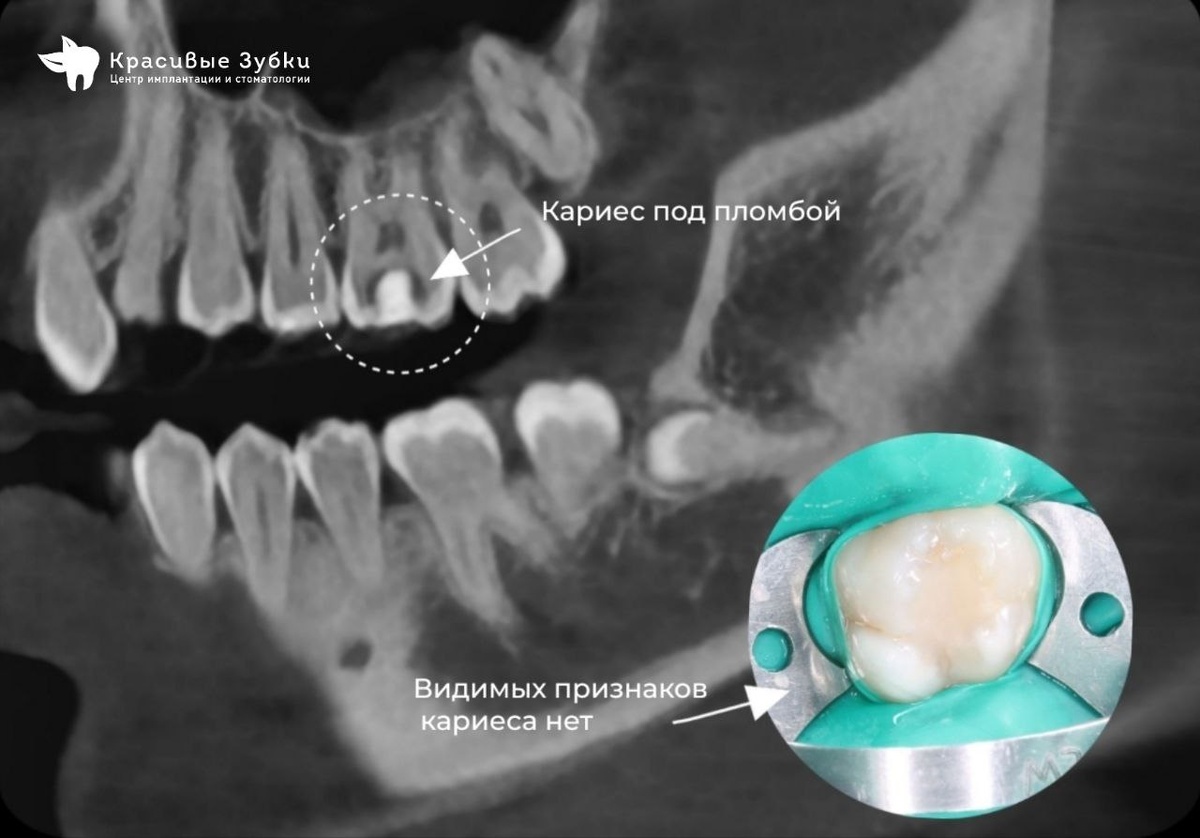 На снимке КТ обнаружен кариес под пломбой.
