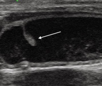 Стрелкой указан полип