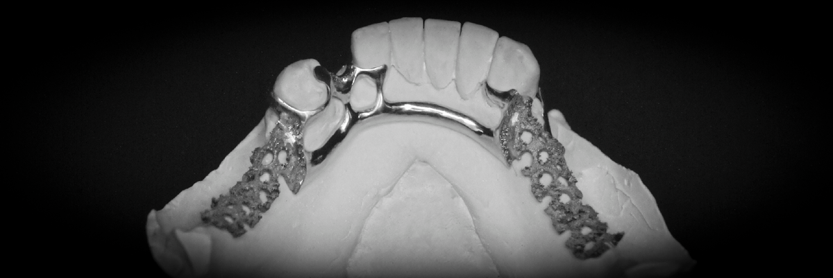 Каркас кламмерного бюгельного протеза из кобальт-хромового сплава.