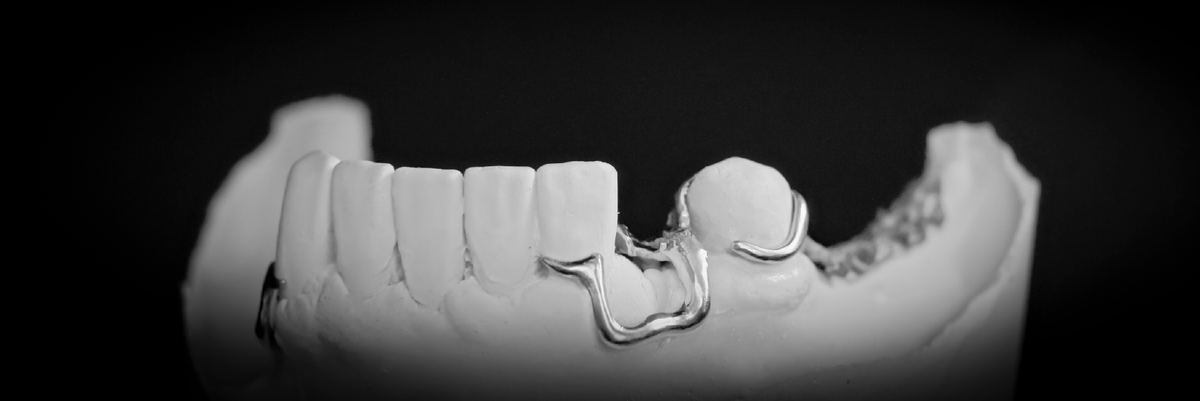 Каркас бюгельного протеза из кобальт-хромового сплава. Тот же что выше - вид спереди.