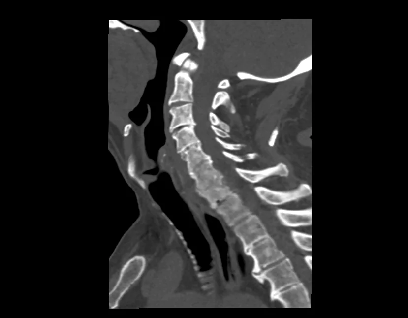                                                                  Лучевая нагрузка при КТ