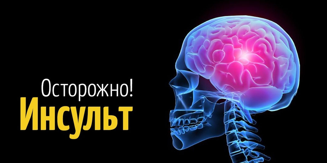 5 необычных симптомов инсульта