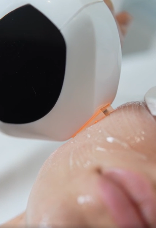 Выполнение процедуры Lumecca. 