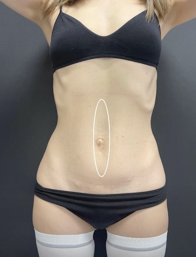 Фото ДО операции. Выпячивание по средней линии живота.