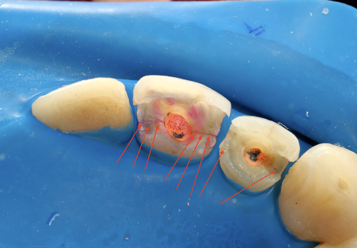 Стрелками отмечены вертикальные трещины корней