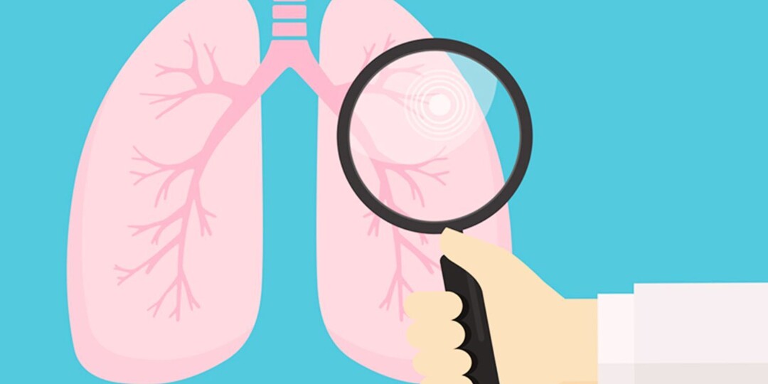 5 симптомов рака легких на ранней стадии