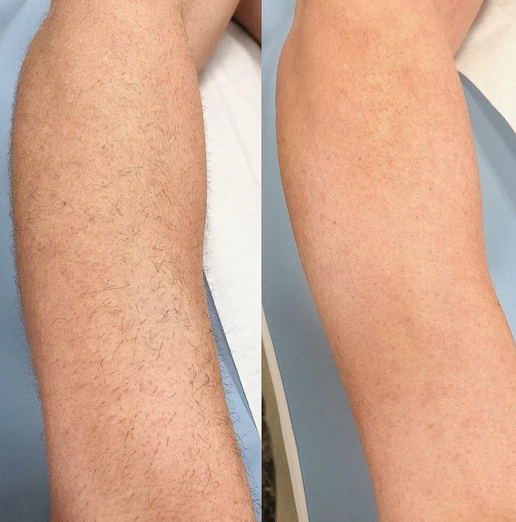 Безопасность и чистота процедуры обеспечит результат