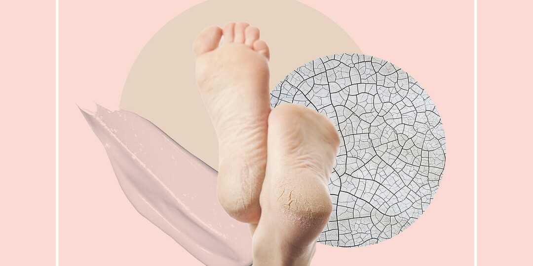 Что делать с сухостью и трещинами на пятках? Советы подолога с 15-летним стажем
