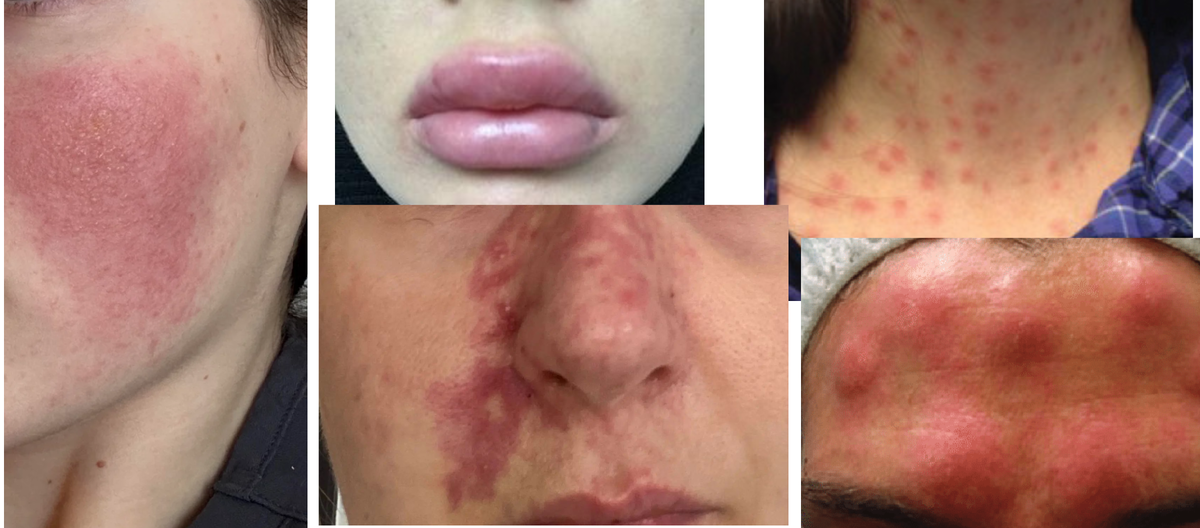 Осложнения после инъекций бывают разные...