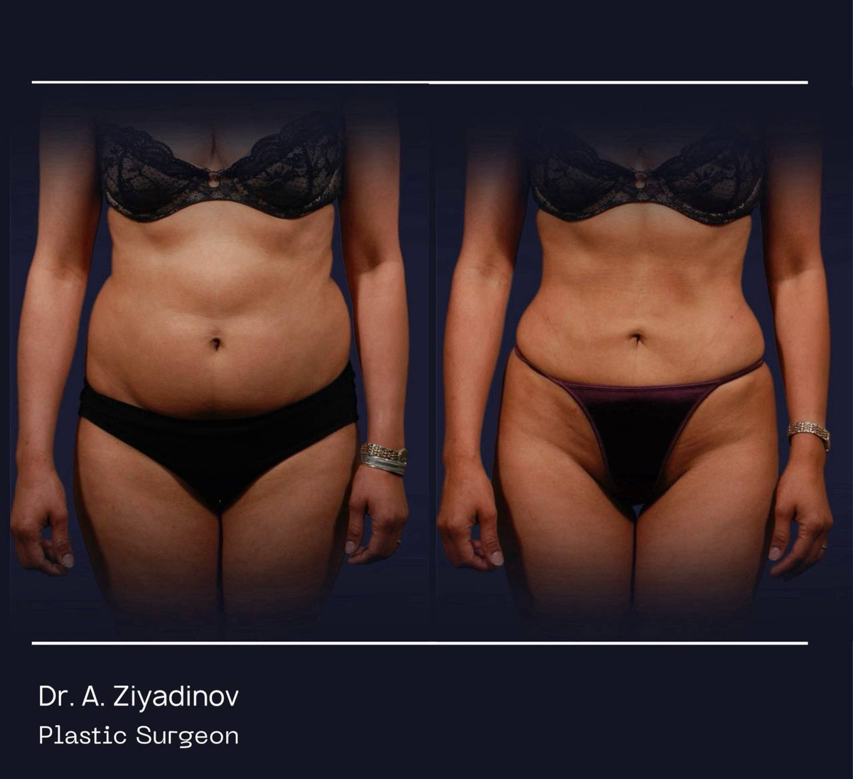 Результат липосакции (до/после)