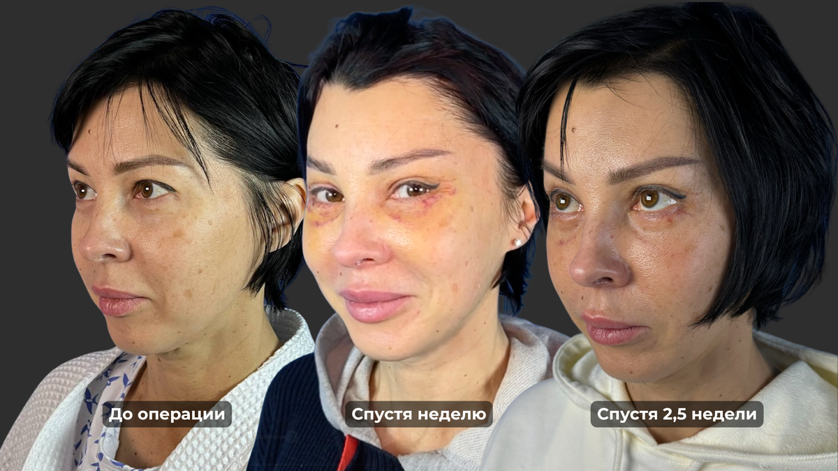 Результаты одной из моих пациенток после подтяжки