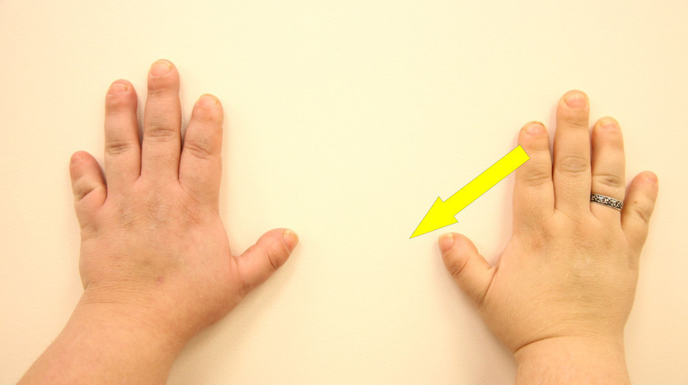    Шестой палец жива ли правда за этим редким явлением