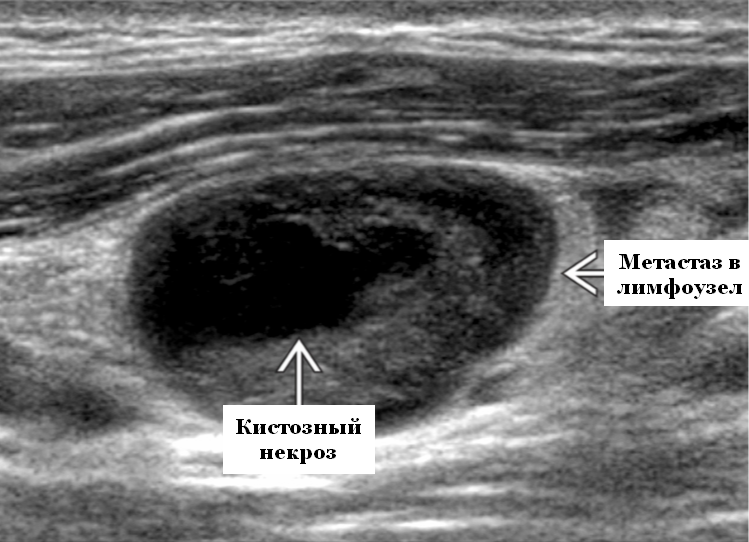 Лимфоузел пораженный метастазом
