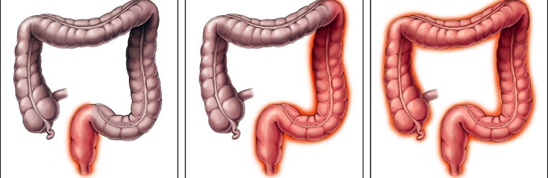 5 симптомов колита, которые часто игнорируют