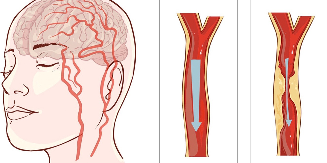3 симптома, что с сосудами головы не всё в порядке