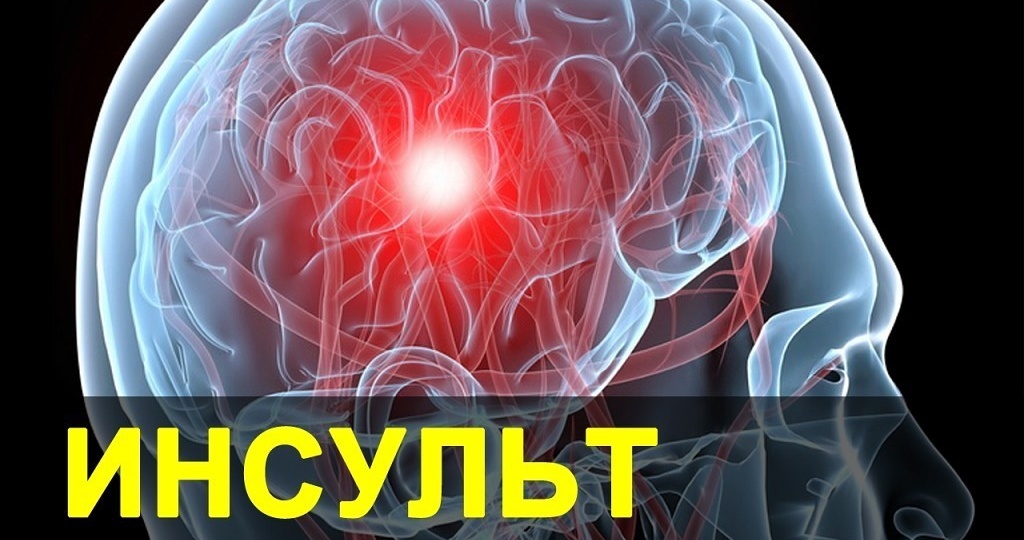 Полная инструкция: как эффективно восстановиться после инсульта — этапы, сроки и методы