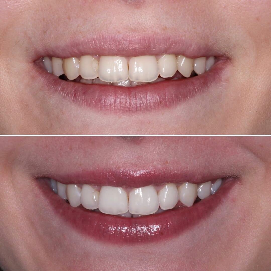 Профессиональная гигиена полости рта плюс отбеливание системой Amazing White premium