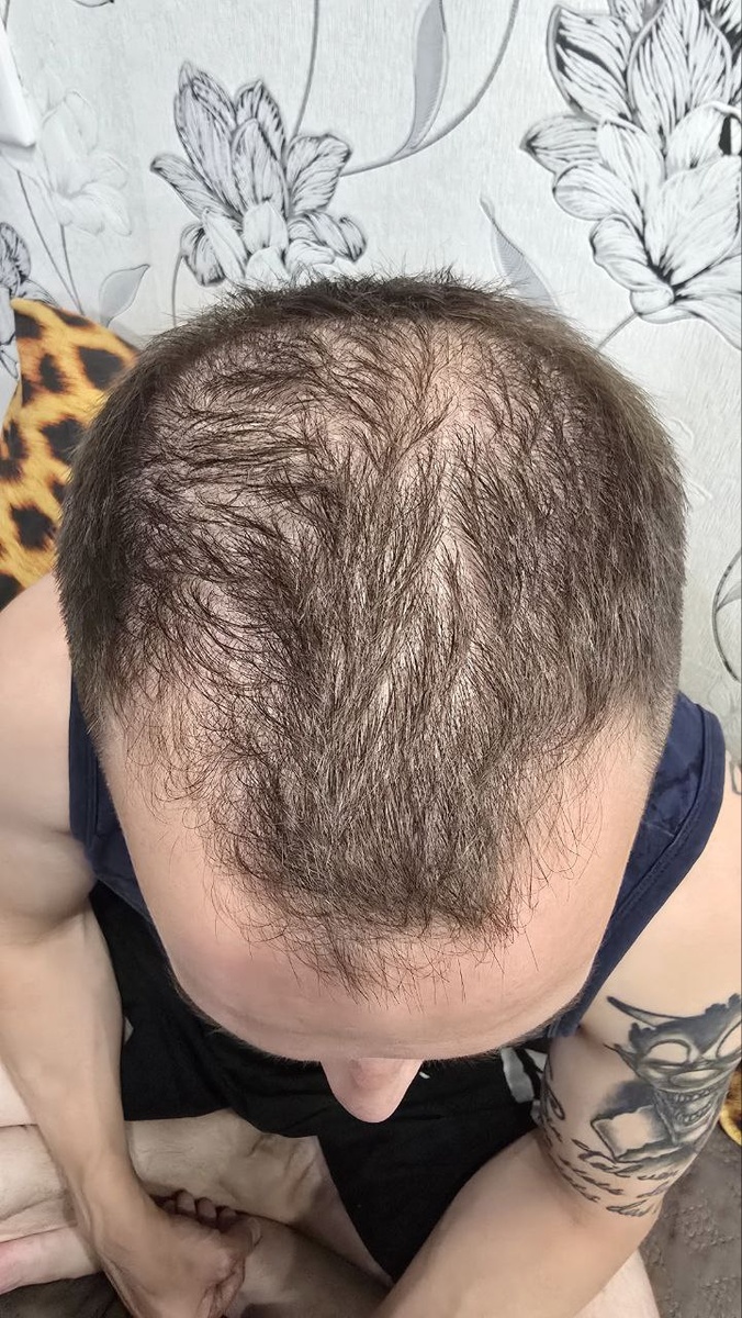 Так выглядели мои волосы в начале июня. Уже были видны проплешины.