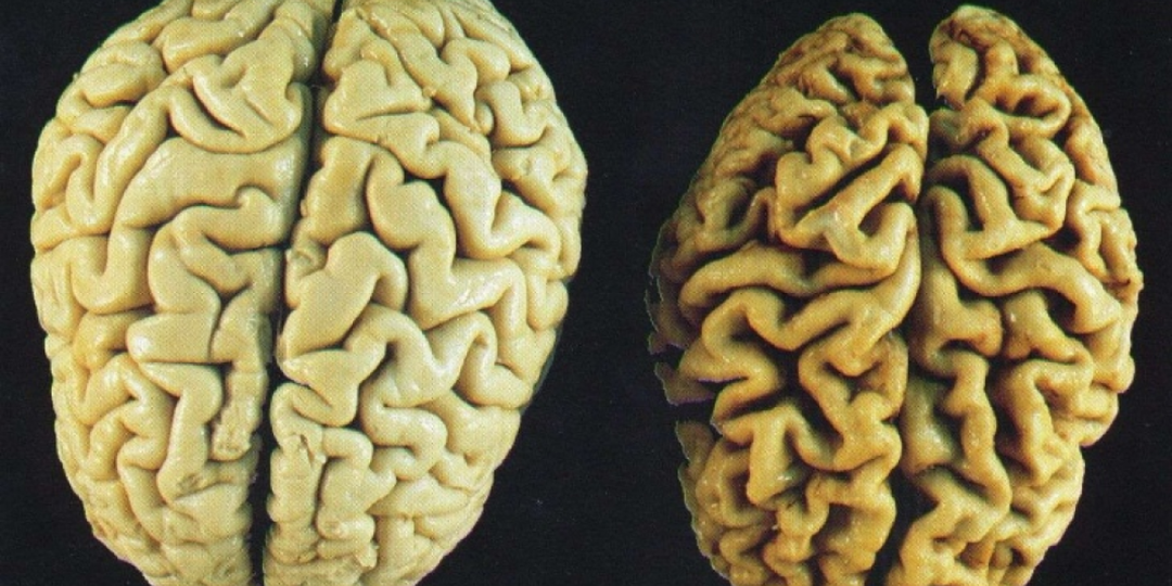 Как понять, что у вас начинается деменция