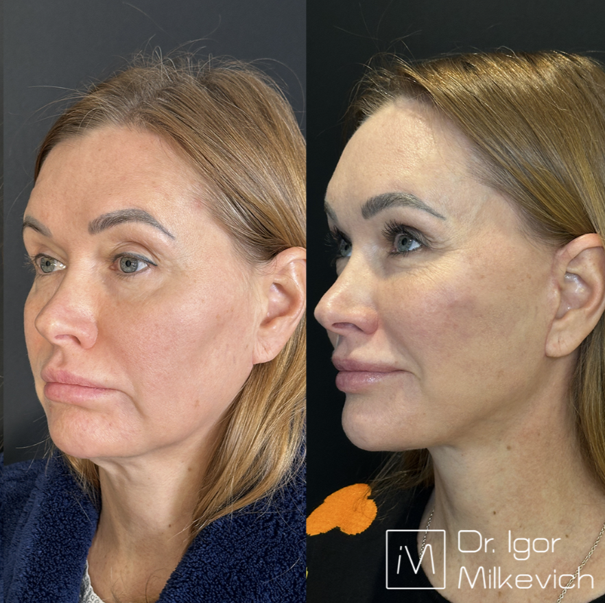 Месяц после хирургического смас-лифтинга