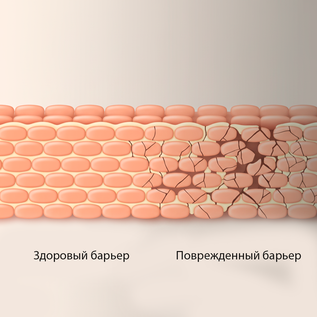 Визуализация кожного барьера на клеточном уровне. Слева — здоровые клетки плотно прилегают друг к другу, создавая надежный защитный щит. Справа — барьер нарушен: связи между клетками ослаблены, что ведет к потере влаги, чувствительности и воспалениям.