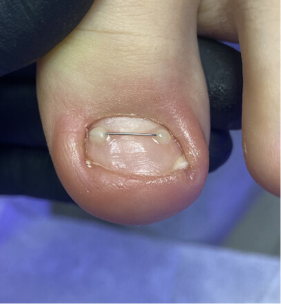 Титановая нить