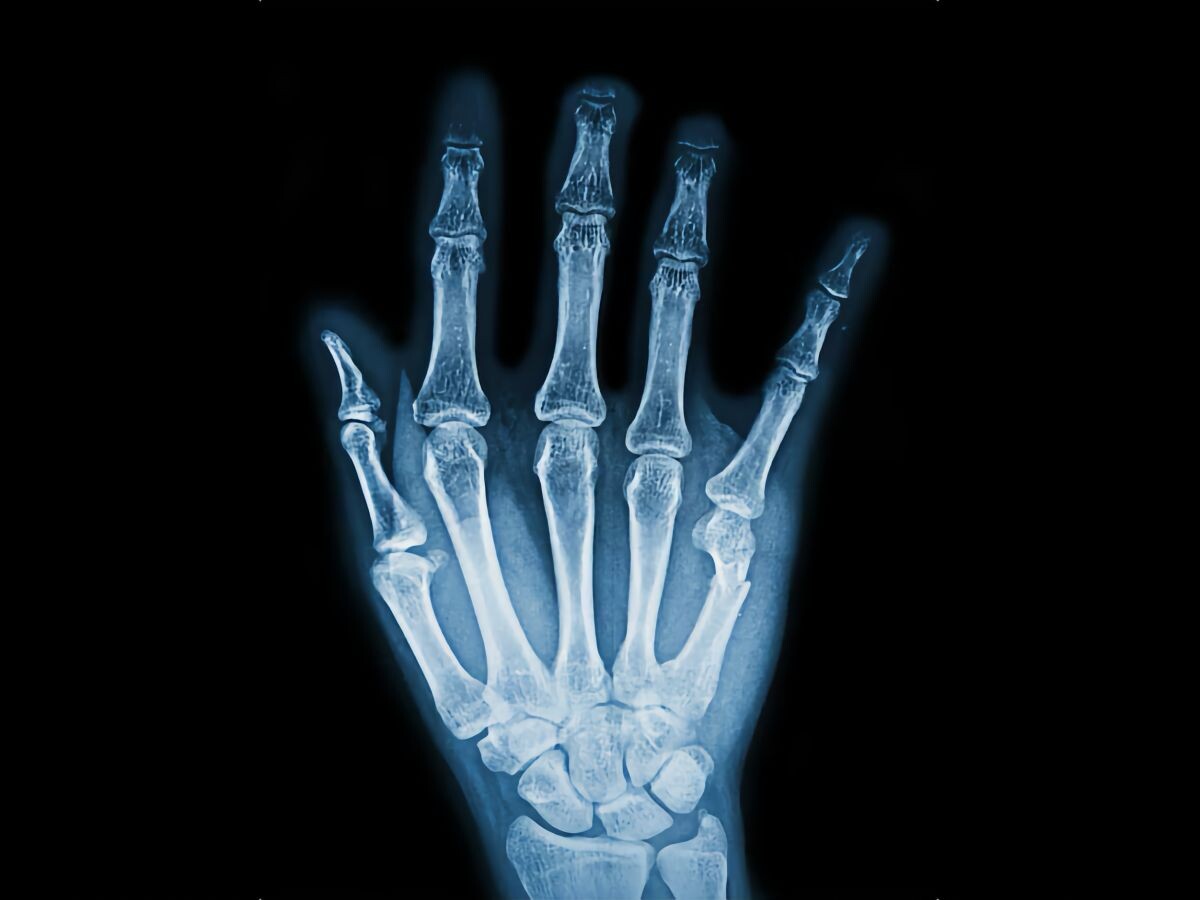    Создан «клеевой пистолет» для печати костей прямо в операционной