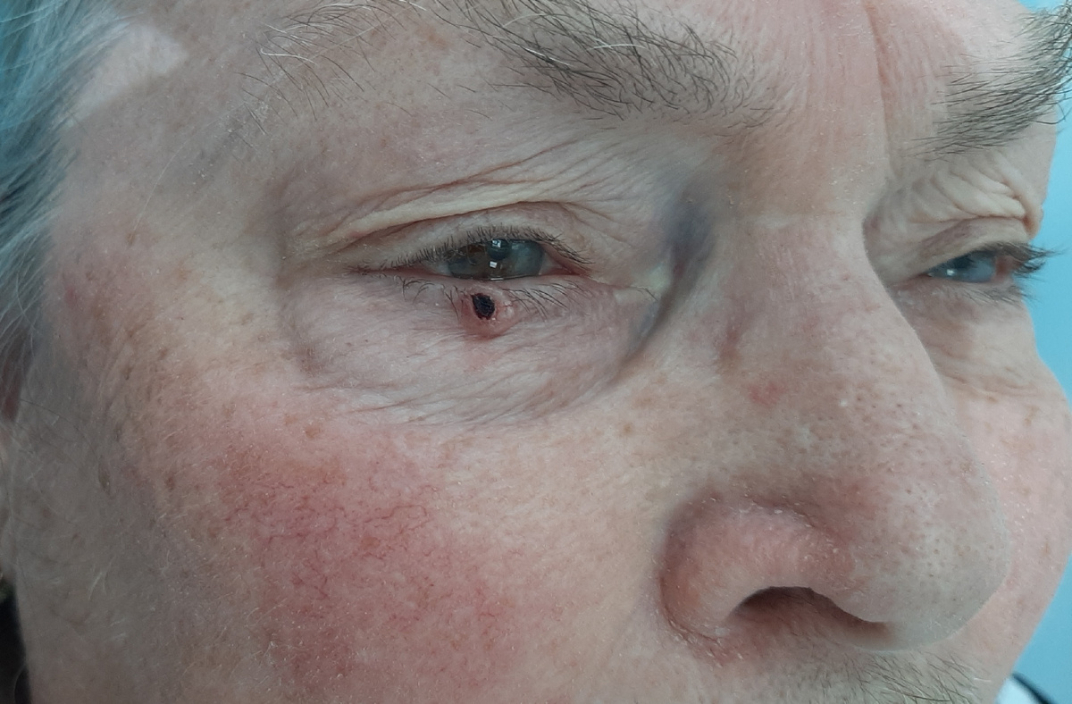 На фото состояние перед операцией. Хорошо видно, что своим верхним краем опухоль распространяться до ресничного края века и почти достигает конъюнктивы.