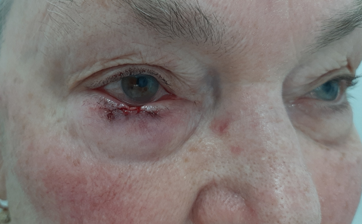 Состояние после операци. На фоне отечности кожи и небольших кровоподтёков видна линия внутрикожного шва и фиксирующие узлы.