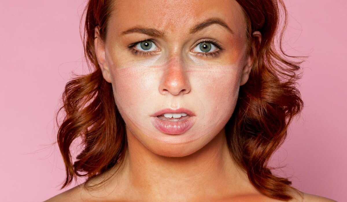     Что выбрать при рубцах после акне: лазер, пилинг или филлеры