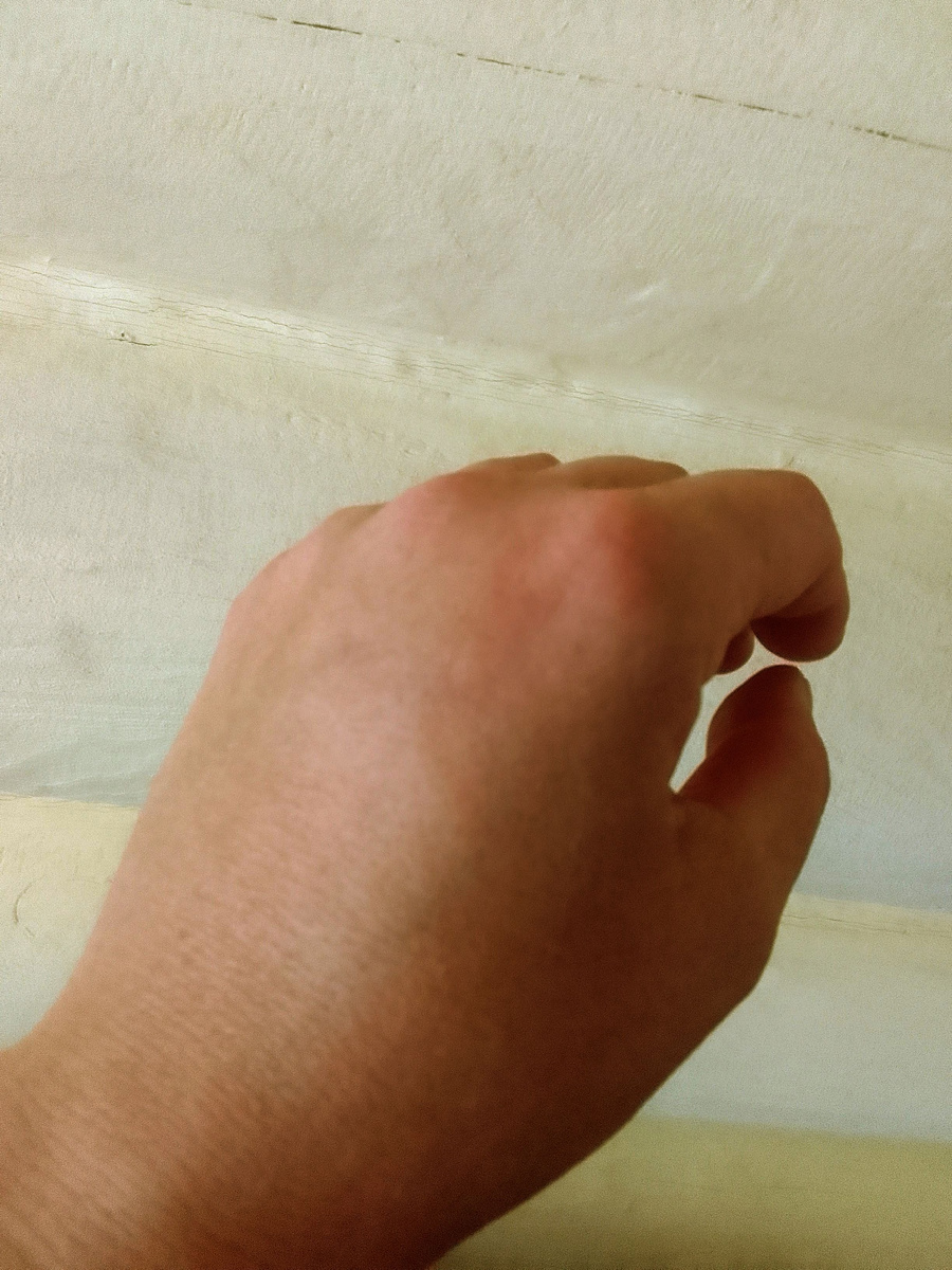 Рука, как боксёрская перчатка стала, точку укуса немного видно, ниже указательного пальца