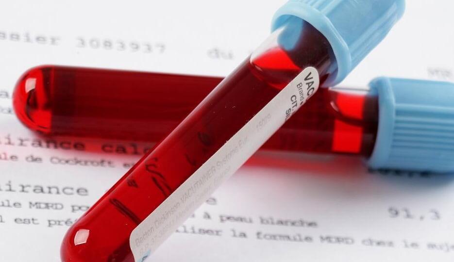 Какие заболевания можно выявить по биохимическому анализу крови? Не только диабет и холестерин — 17 скрытых сигналов