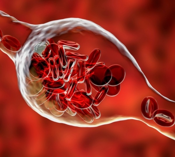 Аневризма, тромб, варикоз, опухоль: как спасти сосуды