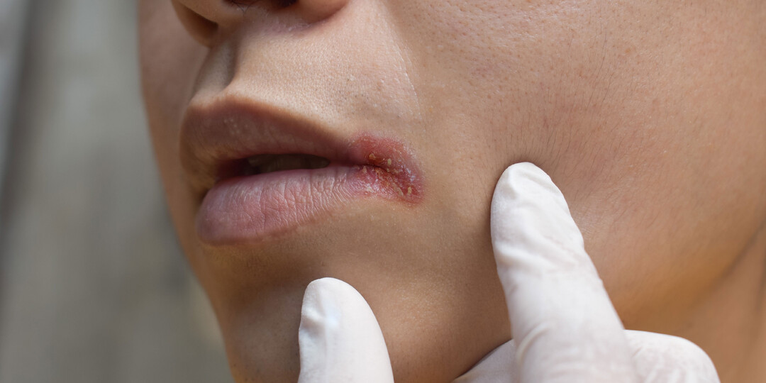 Постоянная сухость во рту: какие болезни стоит исключить