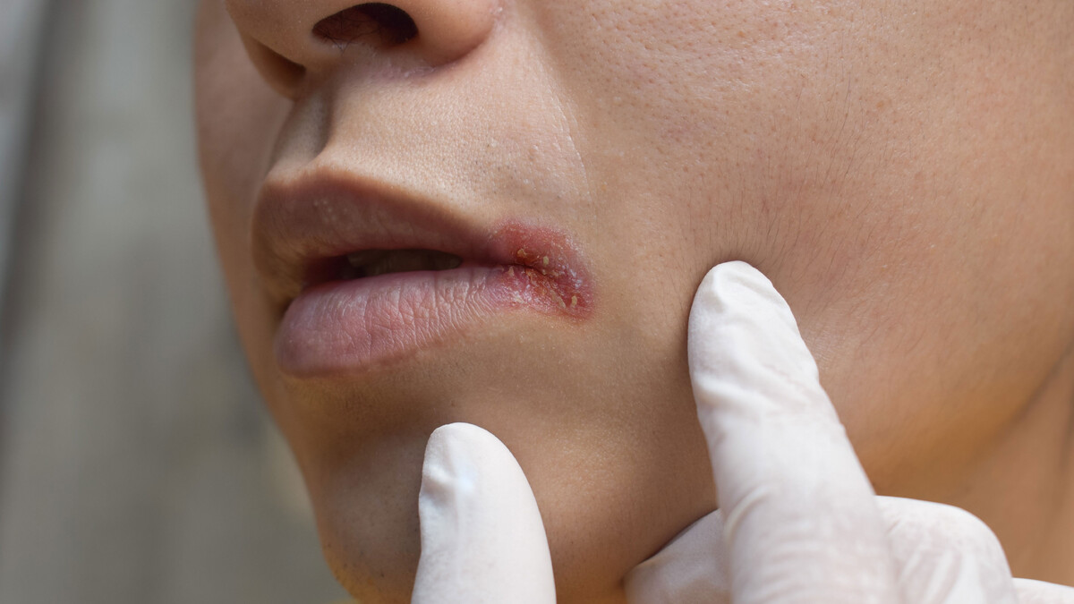 Постоянная сухость во рту: какие болезни стоит исключить