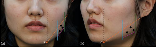 (a) Схематичное изображение инъекций спереди и сбоку,
(b) Схематичное изображение инъекций под углом 45°.
Чёрная пунктирная линия — вертикальная линия от уголка рта.
Точка A — место пересечения чёрной пунктирной линии и края нижней челюсти.
Оранжевая линия — от точки A к мочке уха.
Синяя линия — зона в пределах 1 см от переднего края жевательной мышцы (определяется пальпацией).
Зелёная линия — зона в пределах 1 см от заднего края жевательной мышцы (определяется пальпацией).
Фиолетовая линия — край нижней челюсти.
Чёрные точки — места введения инъекций.