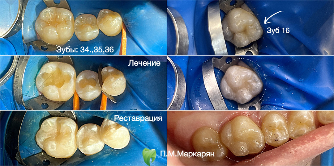 Лечение кариса постоянных зубов у подростков