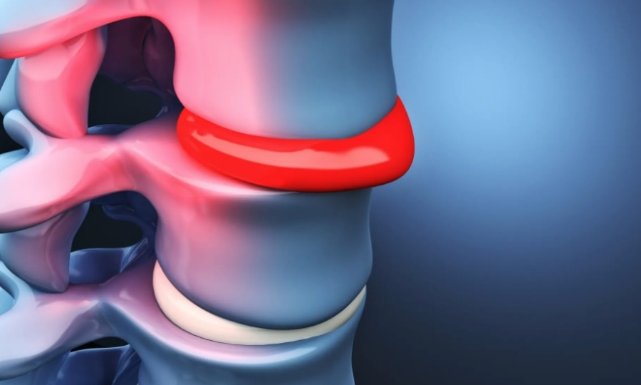 Протрузия и Грыжа. В чем разница?