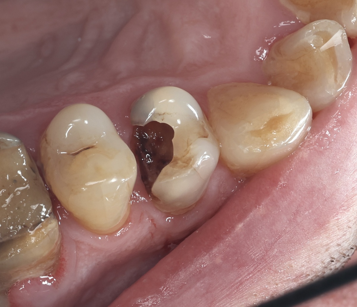 Пульпит, который не болит