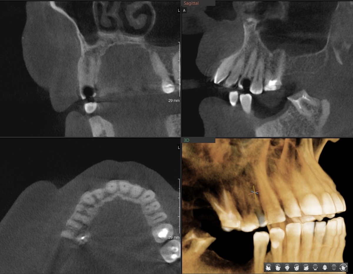 Пульпит 1.4 зуба