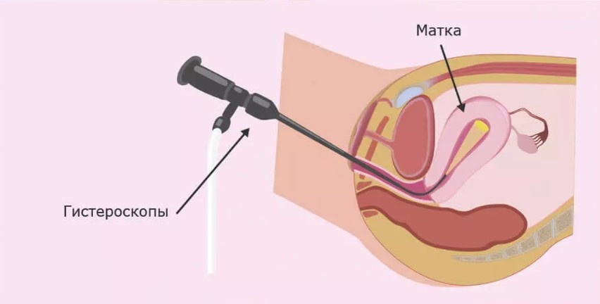 Удаление полипа в матке