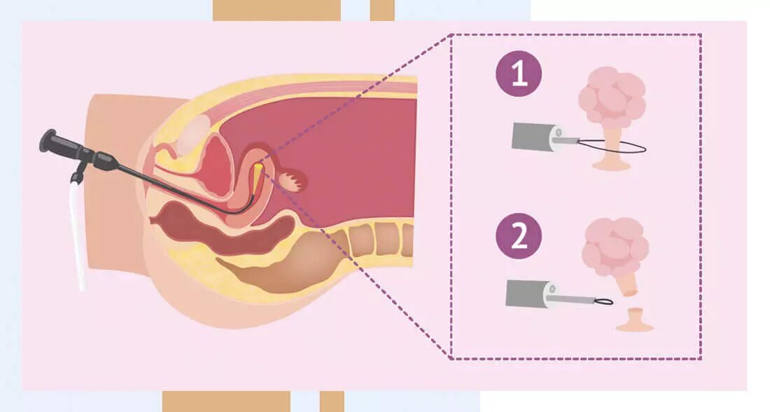 Удаление полипа с помощью гистероскопии
